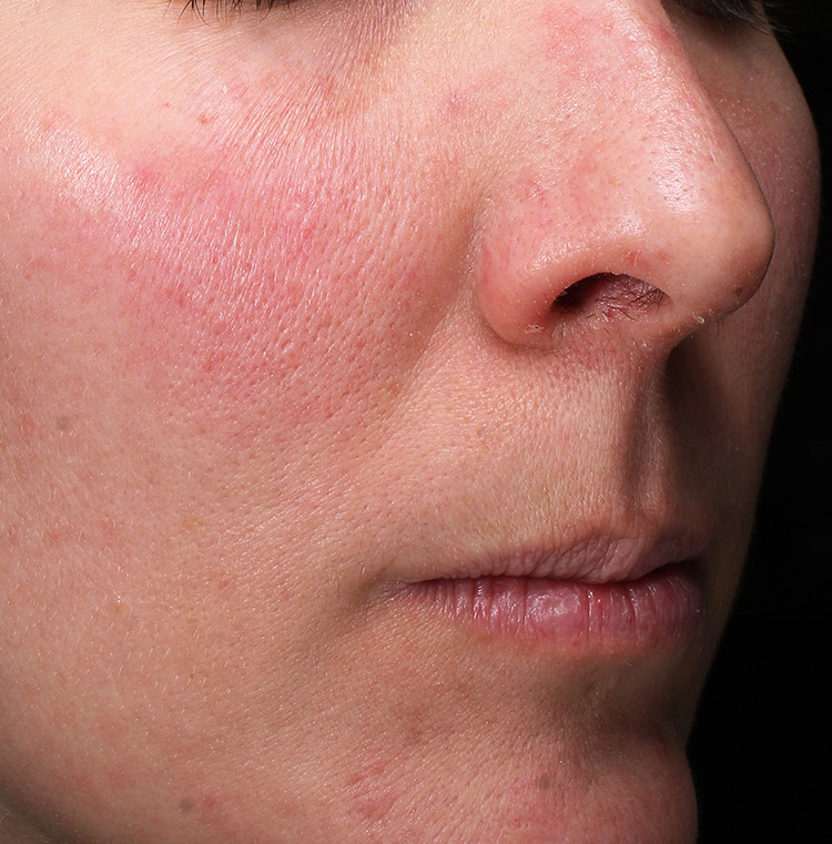 Skin Texture